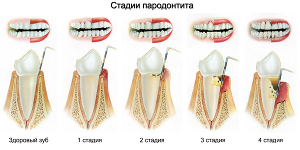stadii-razvitiya-parodontita